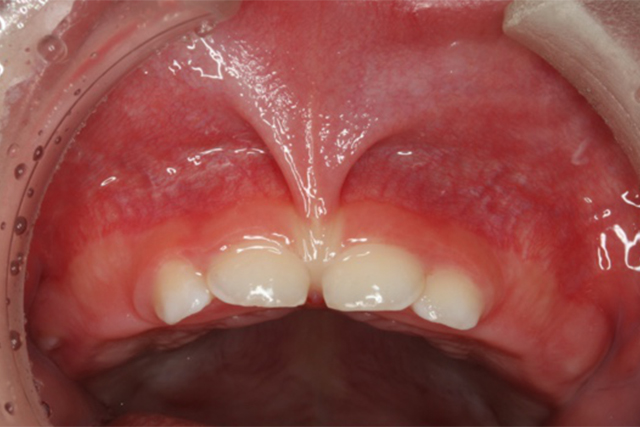上唇小帯高位付着